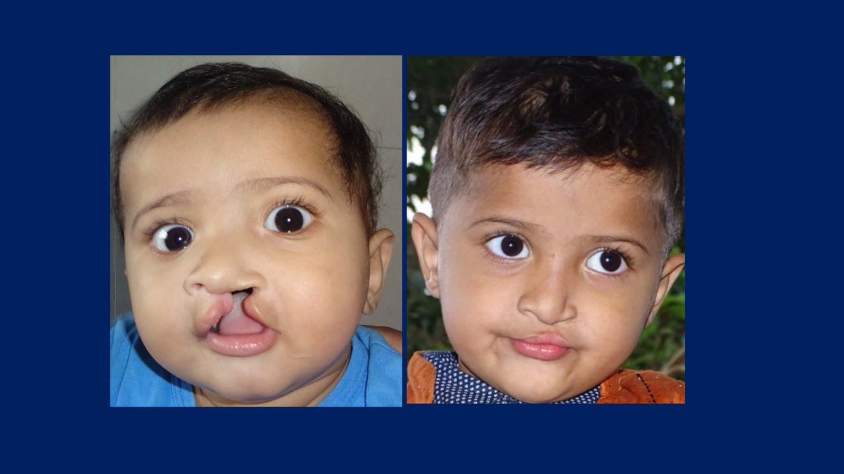 DrBembde's tweet photo. #PowerOfASmile #HealTheCleft
#DrRamakantBembde
#freecleftsurgery
#freecleftlipsurgery #freecleftpalatesurgery
#freecleftsurgeryaurangabad
#smiletrainpartner
#smiletrainaurangabad
#PlasticSurgeryAurangabad #AestheticSurgeryAurangabad
#cleftstrong
#WorldSmileDay2022 https://t.co/jFBu3yDZnB