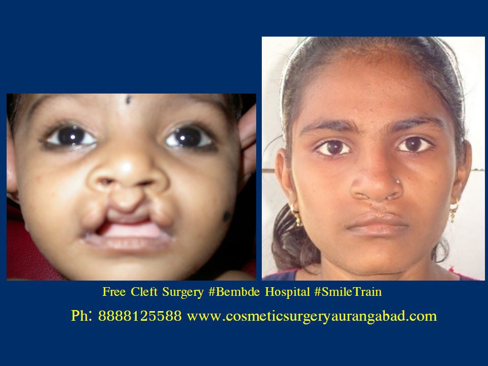 DrBembde's tweet photo. #PowerOfASmile #HealTheCleft
#DrRamakantBembde
#freecleftsurgery
#freecleftlipsurgery #freecleftpalatesurgery
#freecleftsurgeryaurangabad
#smiletrainpartner
#smiletrainaurangabad
#PlasticSurgeryAurangabad #AestheticSurgeryAurangabad
#cleftstrong
#WorldSmileDay2022 https://t.co/jFBu3yDZnB