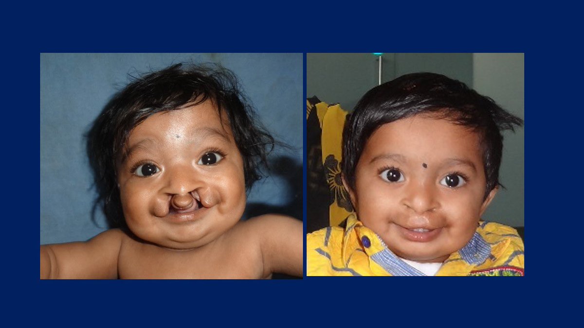 DrBembde's tweet photo. #PowerOfASmile #HealTheCleft
#DrRamakantBembde
#freecleftsurgery
#freecleftlipsurgery #freecleftpalatesurgery
#freecleftsurgeryaurangabad
#smiletrainpartner
#smiletrainaurangabad
#PlasticSurgeryAurangabad #AestheticSurgeryAurangabad
#cleftstrong
#WorldSmileDay2022 https://t.co/jFBu3yDZnB
