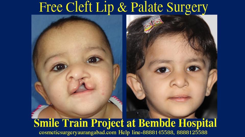 DrBembde's tweet photo. #PowerOfASmile #HealTheCleft
#DrRamakantBembde
#freecleftsurgery
#freecleftlipsurgery #freecleftpalatesurgery
#freecleftsurgeryaurangabad
#smiletrainpartner
#smiletrainaurangabad
#PlasticSurgeryAurangabad #AestheticSurgeryAurangabad
#cleftstrong
#WorldSmileDay2022 https://t.co/jFBu3yDZnB