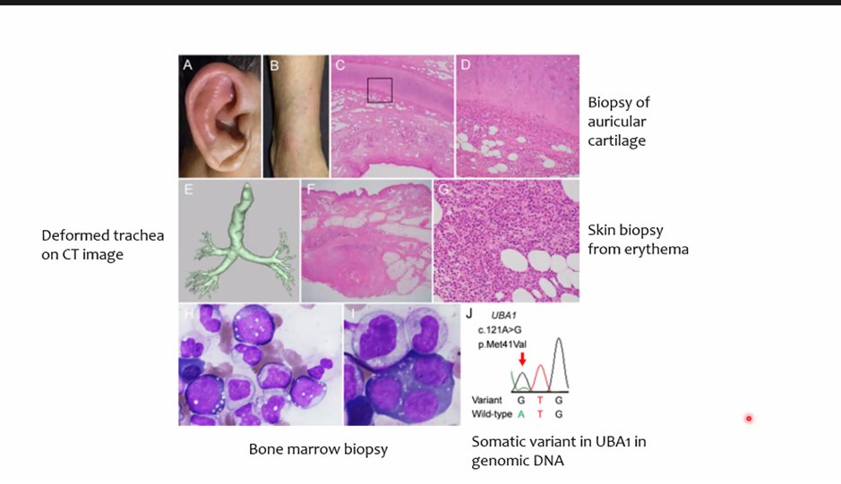 UTSWRheum's tweet photo. What is your diagnosis? 
55 yo male with fever, swollen, painful ear, vasculitic skin lesions, inflammatory arthritis, anemia, thrombocytopenia. He cannot taper prednisone < 20 mg/d and has not responded to DMARDS. Path shown below @Kay_Shwin #UTSWIMchief #IMGr https://t.co/IWB03ZZfba