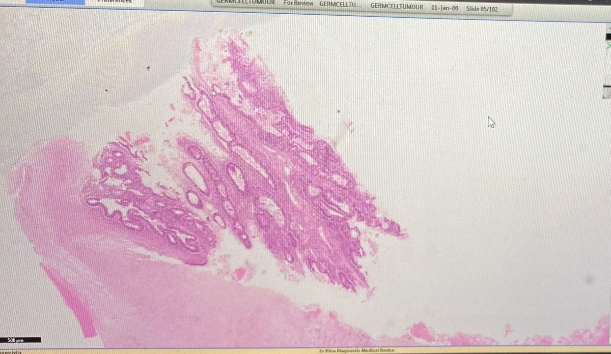 BAGPGynPath's tweet photo. BAGP Long course 2022: Dr Baljeet Kaur lecture & slide seminar on Germ cell tumours #Surgpath #BAGP #PathTwitter #gynaepath #patholog https://t.co/KJFff2GGuT