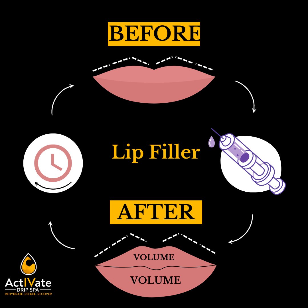 ActIVateDripSpa's tweet photo. BEFORE.
Lip Filler!👄🫦
AFTER.
---
📲- Toll Free: 1 (866) 221-1727
💌- Info@activatedripspa.com
(Book Now)
👇
👇
👇
👇
🙏Follow on
More updates- https://t.co/2QmuXgzk9o
#actiVatedripspa #dermalfillers #Houstonbotox #houstonfillers #DrTasha #ivhydration #ivhydrationtherapy #iv https://t.co/b6Jl3rptqF