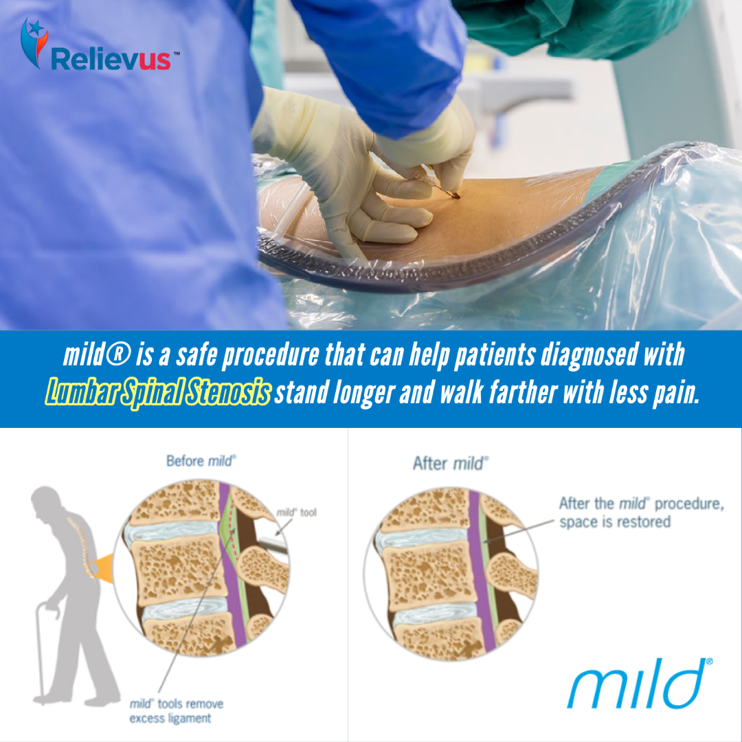mild® is a short, outpatient procedure, performed through a very small incision (about the size of a baby aspirin) that requires no general anesthesia, no implants, and no stitches.

relievus.com/mild-procedure/
888-985-2727

#painmanagement #managepain #relievus #mildprocedure