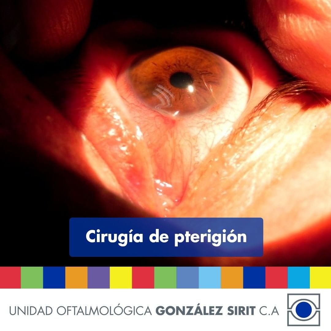 GonzalezSirit's tweet photo. ¿En qué consiste la cirugía de pterigión? En la Unidad Oftalmológica González Sirit #UOGS te explicamos el procedimiento,solo debes hacer click en el enlace:
https://t.co/FF8vrPcmbx
#TuVisiónEsNuestraMisión https://t.co/0QnAiVQP7c