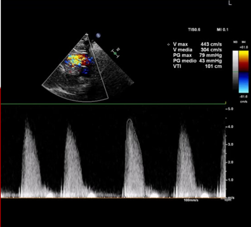 Quando l’ecocardiogramma è necessario… ma non sufficiente. Sul #GIC un caso di stenosi aortica severa normal-flow low-gradient con valutazione multimodale, by Cantone, Guardigli e Passarini
giornaledicardiologia.it/archivio/3881/…