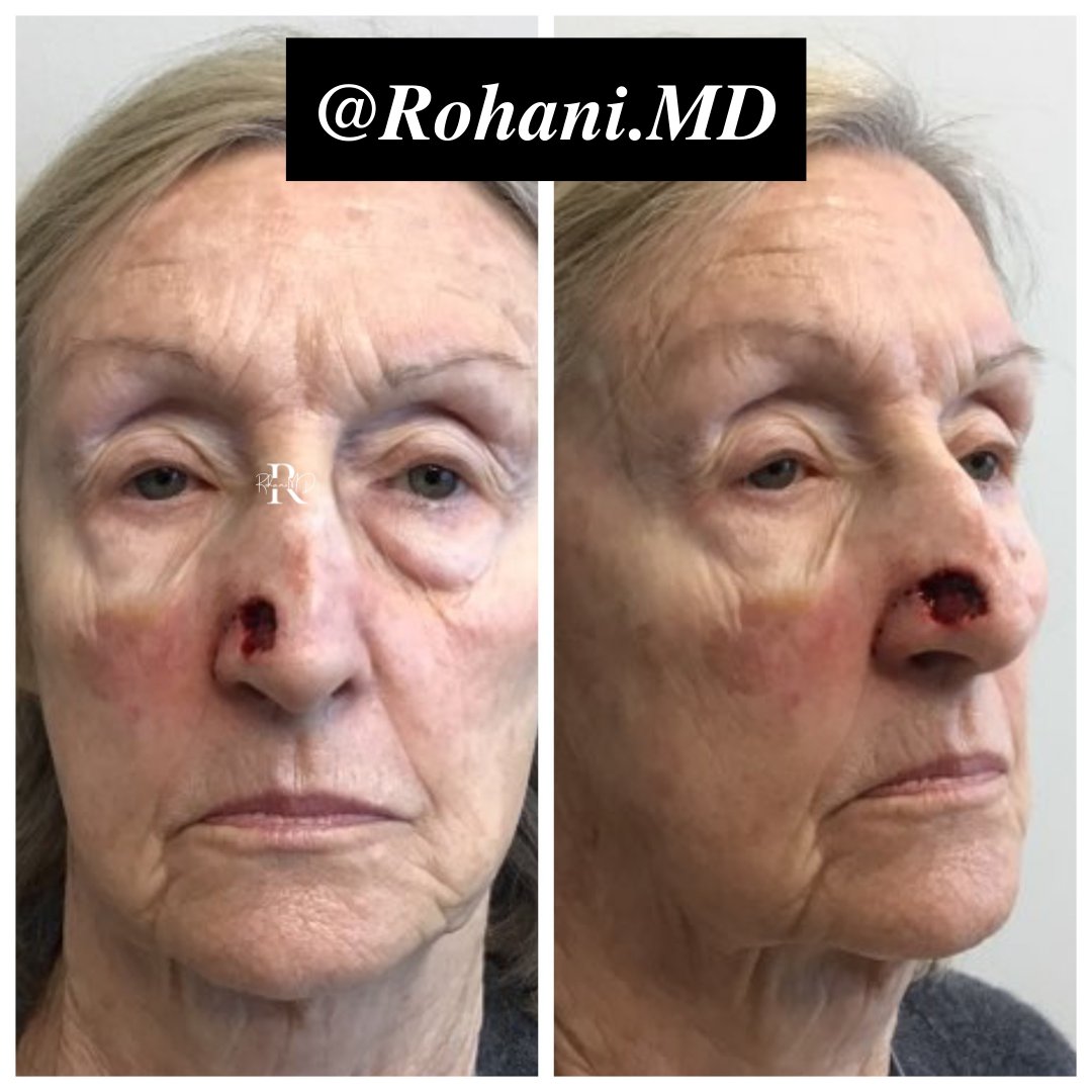 MohsCollege's tweet photo. Flap Friday Part One: A 78-year-old woman presented for Mohs micrographic surgery of a superficially-invasive well-differentiated squamous cell carcinoma affecting the right nasal ala. How would you repair this? #flapfriday https://t.co/TR8WcNdc96