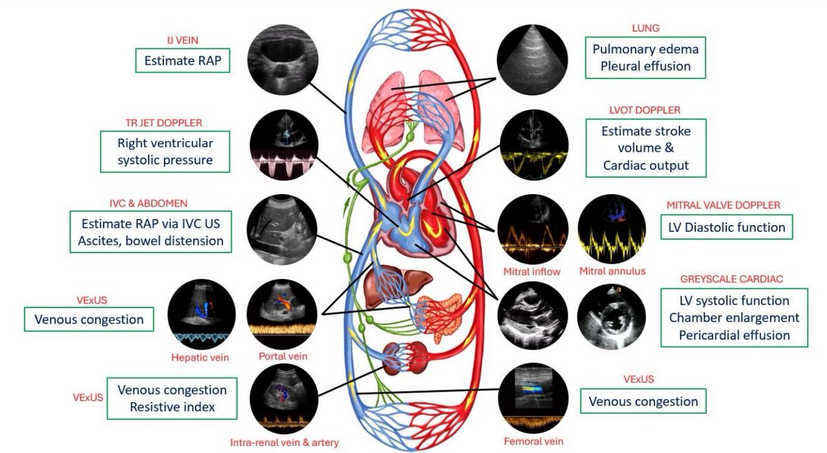 ASNKidney360's tweet photo. Over the past several years, POCUS has evolved as a valuable adjunct to physical examination, though it remains largely underutilized in nephrology. This Perspective discusses the application of POCUS in cirrhosis-associated AKI https://t.co/kHfRWGv2ON https://t.co/7Qii1sqUTT