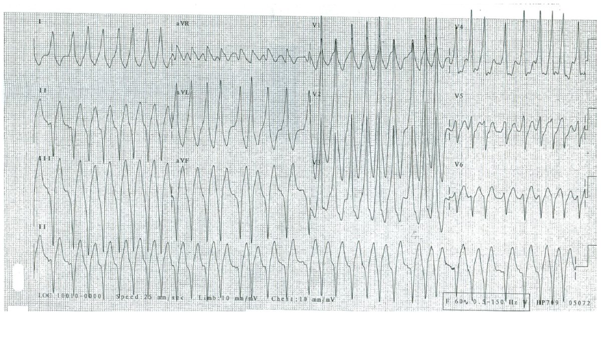 PrashantBhave11's tweet photo. Young patient, no medical history, presents with palpitations. Thoughts? https://t.co/W9L909AYEw