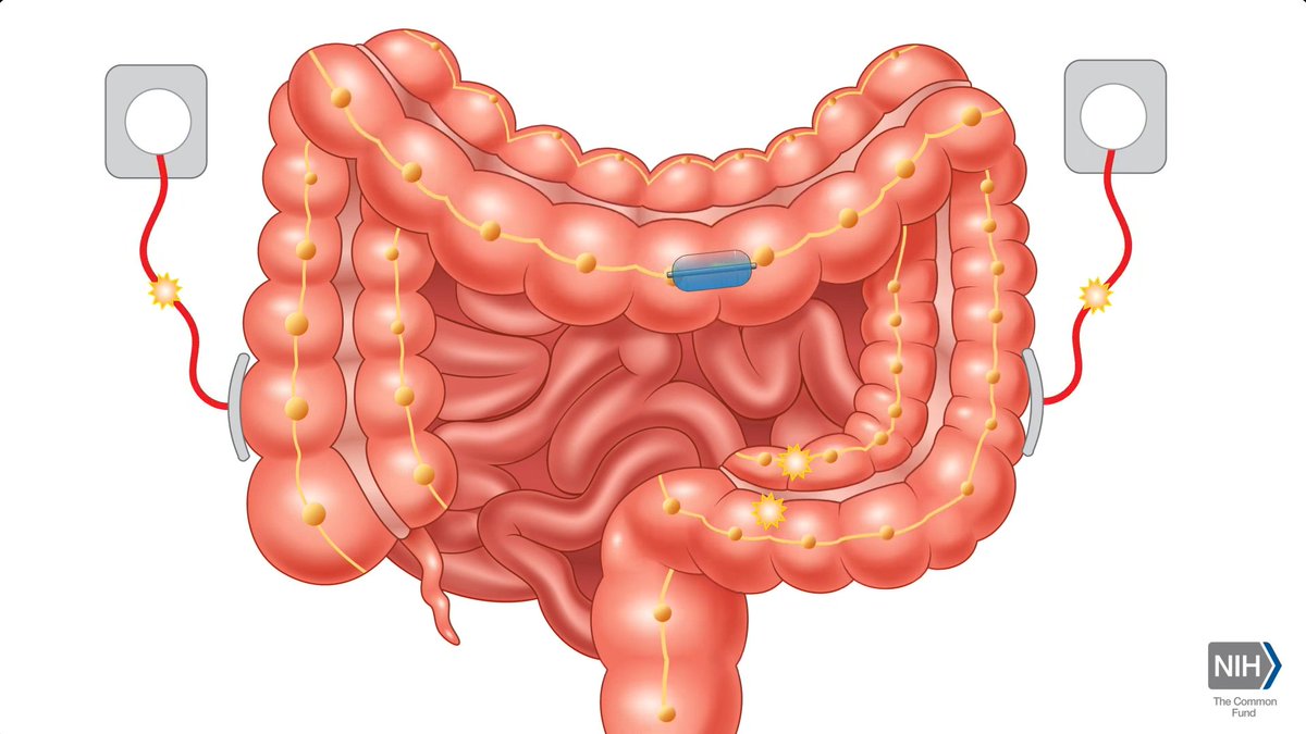 sparc_science's tweet photo. Today is #bioelectronic medicine day! 2SPARC healing in the gut #Fecobionics #biosensor developed by #NIH_SPARC researchers to help understand #gastrointestinalhealth &amp; #peripheralnervoussystem https://t.co/668H6qehrf 
#neuroscience #GItwitter @ACG_CTG #neuromodulation @bvhpatel https://t.co/oHKJuqme8Q
