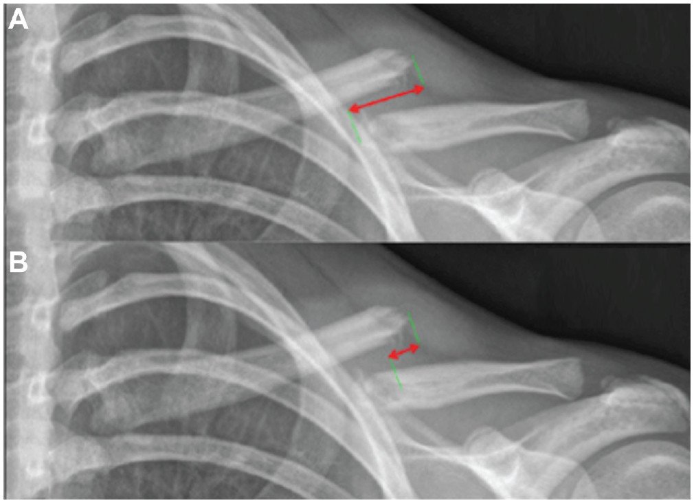 Surgery demonstrated no benefit in patient quality of life, satisfaction, function, or prevention of complications following completely displaced #claviclefractures in adolescents at 2 years after injury. <a href="/BostonChildrens/">Boston Children's</a> ow.ly/bH8y50KIhI7