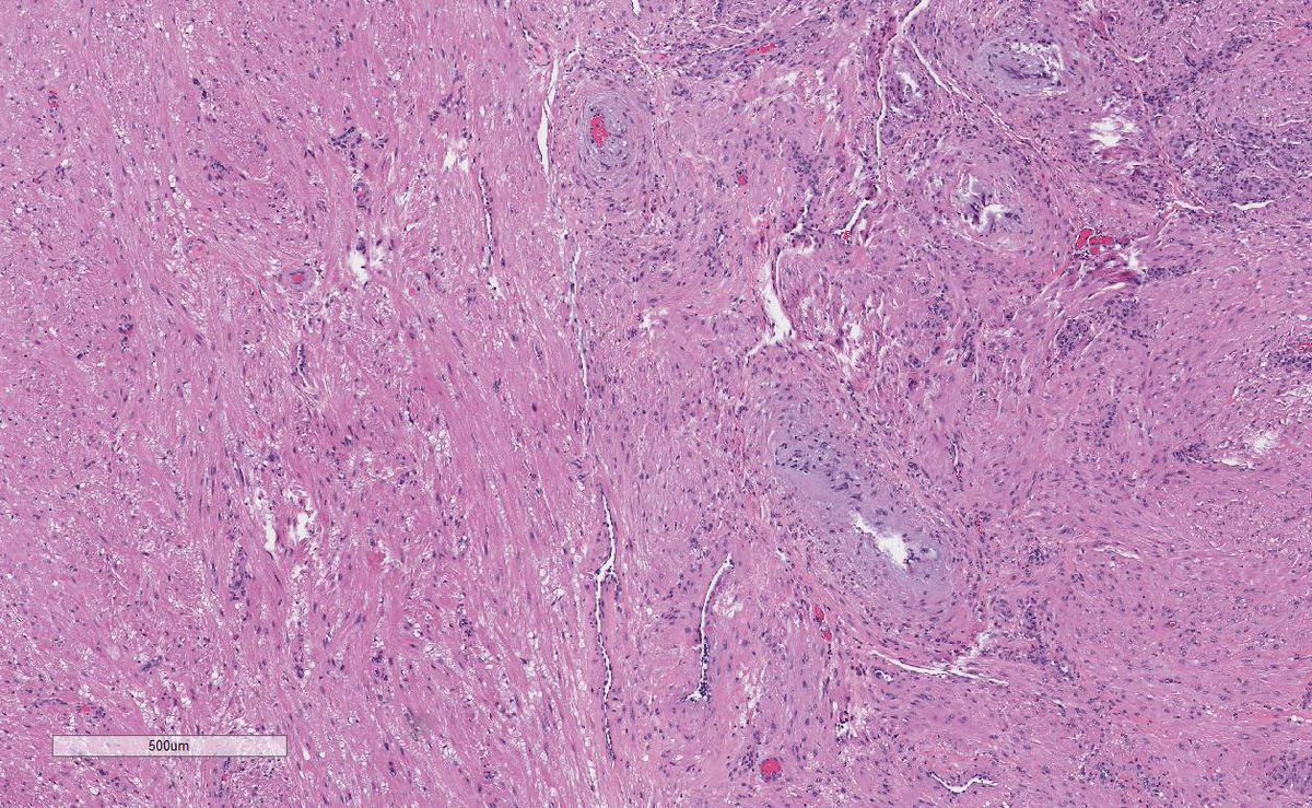 Adult patient, painful tumor, lower leg. #dermpath #pathology #dermatology #dermtwitter