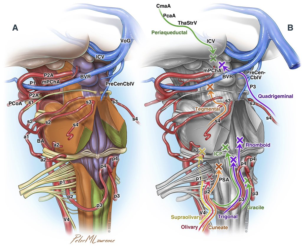 Peter M. Lawrence (@petermlawrence1) on Twitter photo Another BSCM “map” from the recently published neurosurgical cartography paper by <a href="/mtlawton/">Michael T. Lawton, MD</a> <a href="/graffeo/">Christopher S. Graffeo, M.D., M.S.</a> <a href="/visishs/">Visish M. Srinivasan, MD</a> et al. Full article: doi.org/10.3171/2022.8… #neuroscience Another BSCM “map” from the recently published neurosurgical cartography paper by <a href="/mtlawton/">Michael T. Lawton, MD</a> <a href="/graffeo/">Christopher S. Graffeo, M.D., M.S.</a> <a href="/visishs/">Visish M. Srinivasan, MD</a> et al. Full article: doi.org/10.3171/2022.8… #neuroscience