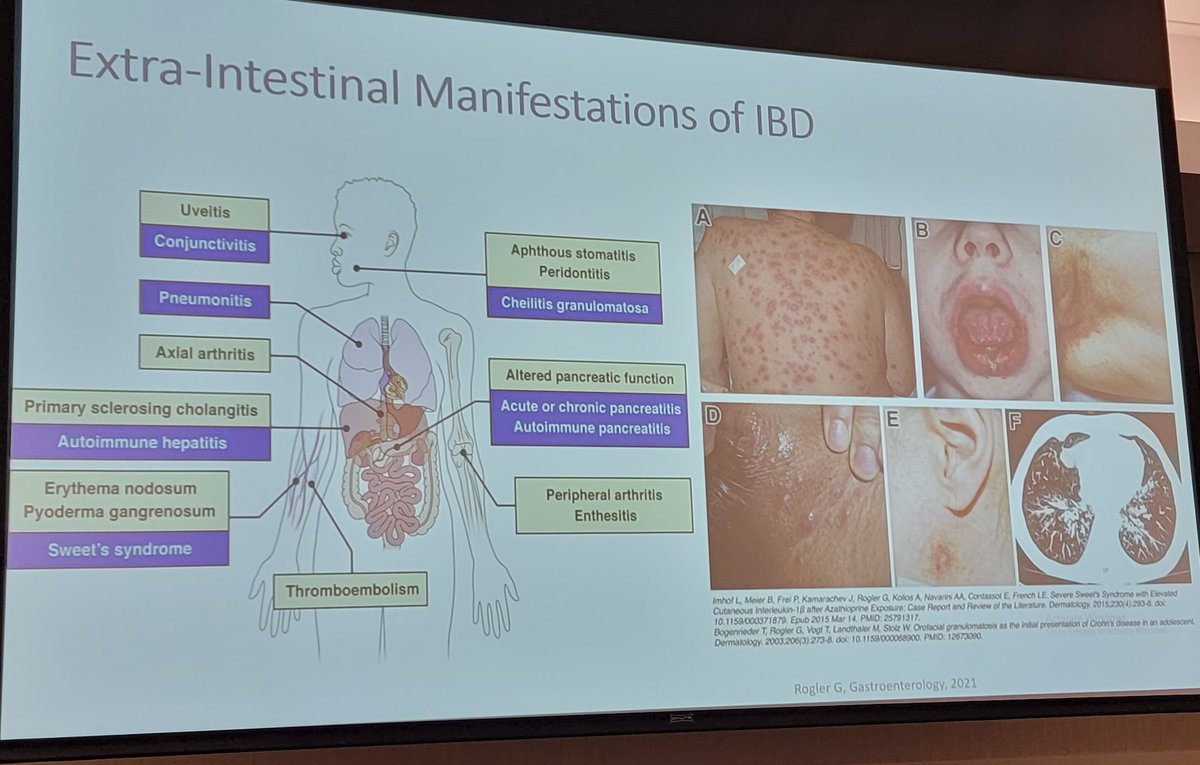 Ruben Hernaez (@ruben_hernaez) on Twitter photo <a href="/LukaszKwapisz/">Lukasz Kwapisz, MD</a> with important pearls in patients with extra-intestinal manifestation of ibd <a href="/bcm_gihep/">BCM Gastroenterology</a> #bcmgiboard <a href="/LukaszKwapisz/">Lukasz Kwapisz, MD</a> with important pearls in patients with extra-intestinal manifestation of ibd <a href="/bcm_gihep/">BCM Gastroenterology</a> #bcmgiboard