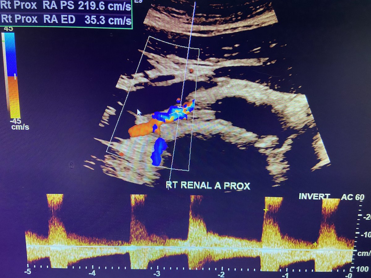 Rare and beautifully scanned renal duplex where you can actually see multifocal beading of #FMD on grayscale w/ the classical color and spectral #Doppler turbulence. Timely reminder of the artistry and skill of our vascular technologists as we celebrate sonography awareness month
