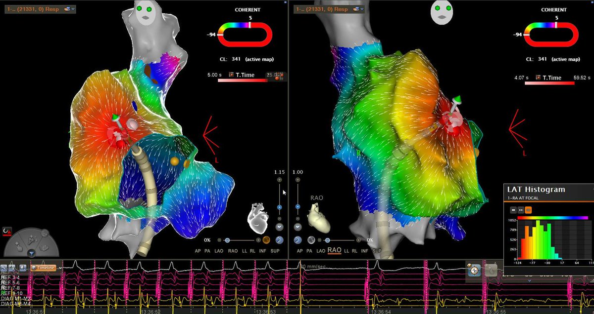 RDUH Electrophysiology Team tweet media