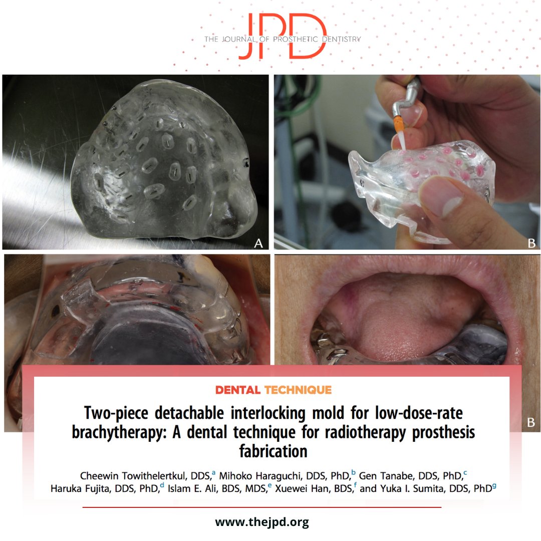 JPDentistry's tweet photo. This #inpress article shares how techniques in #prosthodontics are applied to create unique interlocking #removableprostheses to support #radiationtherapy that both targets the site of #oralcancer while protecting uninvolved surrounding tissues: https://t.co/LeLBYJHpVx https://t.co/ZwyZBVUtEM