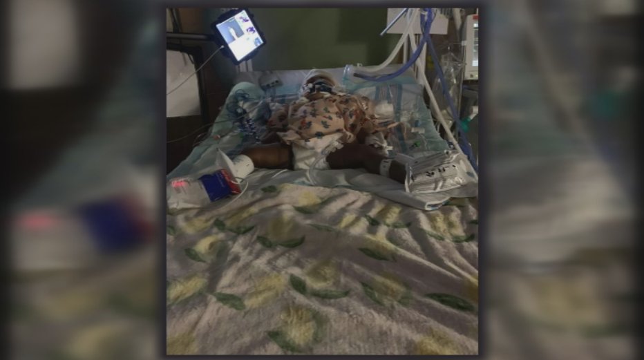 1-year-old suffers severe burns from father pouring boiling water on