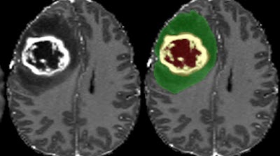 New publicly available MR images of diffuse #glioma: <a href="/UCSFimaging/">UCSF Imaging</a> dataset doi.org/10.1148/ryai.2… <a href="/ecalabr/">Evan Calabrese, MD PhD</a> <a href="/SpyridonBakas/">Spyridon Bakas</a> <a href="/MonganMD/">John Mongan</a> #NeuroRad #BrainTumor #AI