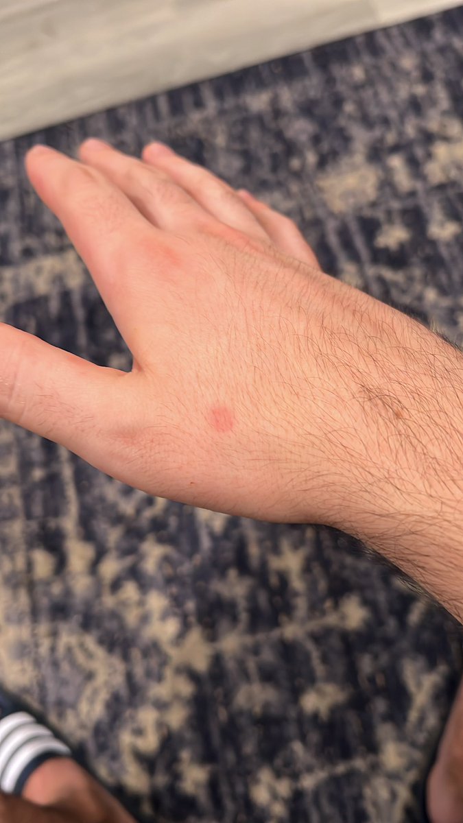 When you try to prove to your pt that liquid nitrogen doesn’t hurt. Not my best idea.