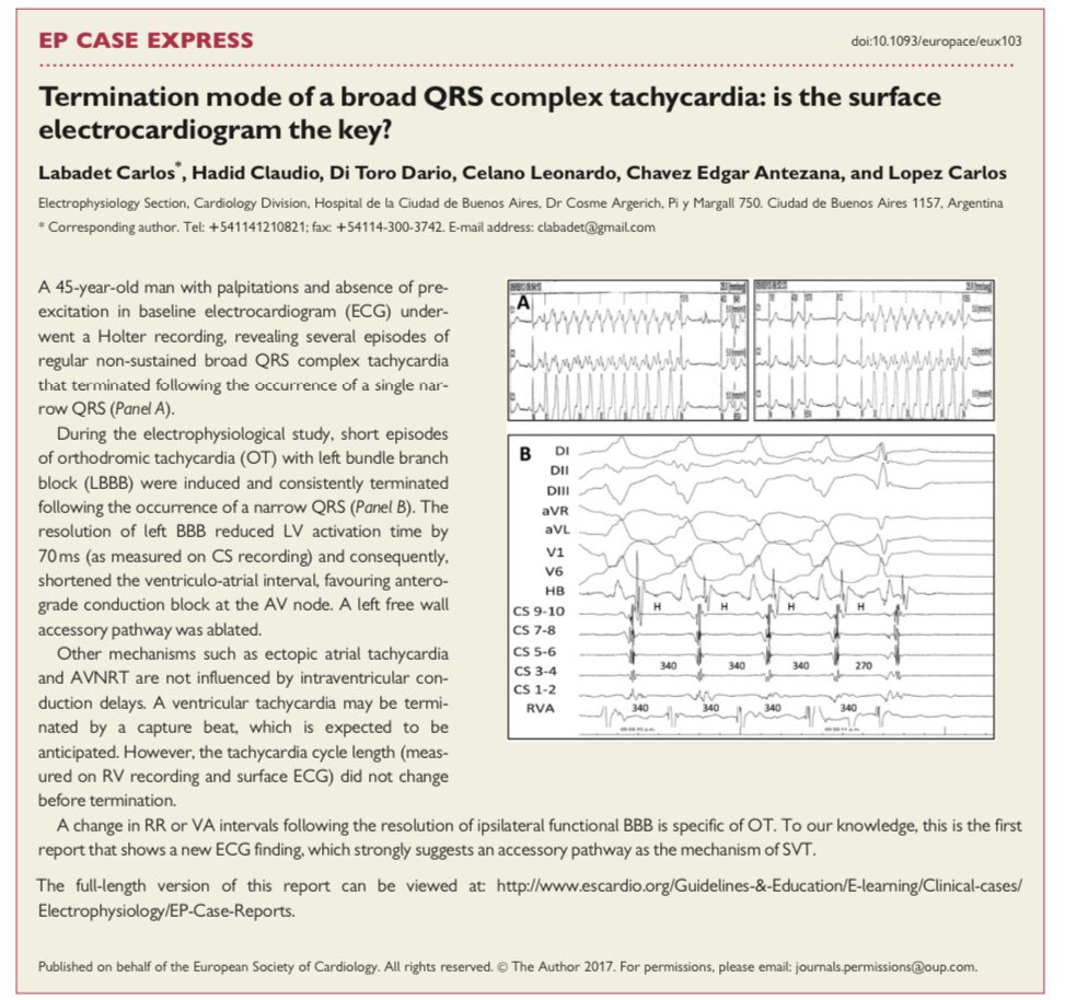 Based on the twitter posted by @syamkumarmd How can we make a accurate diagnosis from a challenge telemetry tracing of Wide complex tachycardia? Labadet et. al. from Argentina found this interesting finding. It worths reading it. doi: 10.1093/europace/eux103.