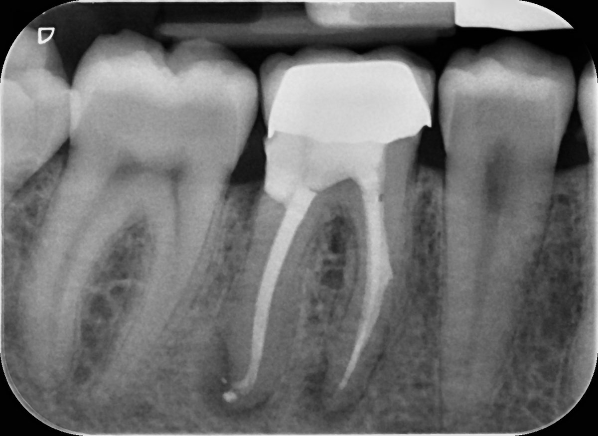 Complex reRCT showing early signs of healing at 6 months but here is how it was done! 🤣

youtu.be/MlwlWQq0bpk
