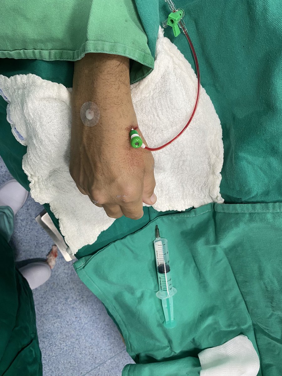dimitri_zappi's tweet photo. 🎯 Convenient, shorter and simpler hemostasis, higher autononomy, minimal RAO 🎯. For skilled radialists a little step, for the patients a huge one. #dTRAFirst whenever possible! https://t.co/BUyKU34VXQ