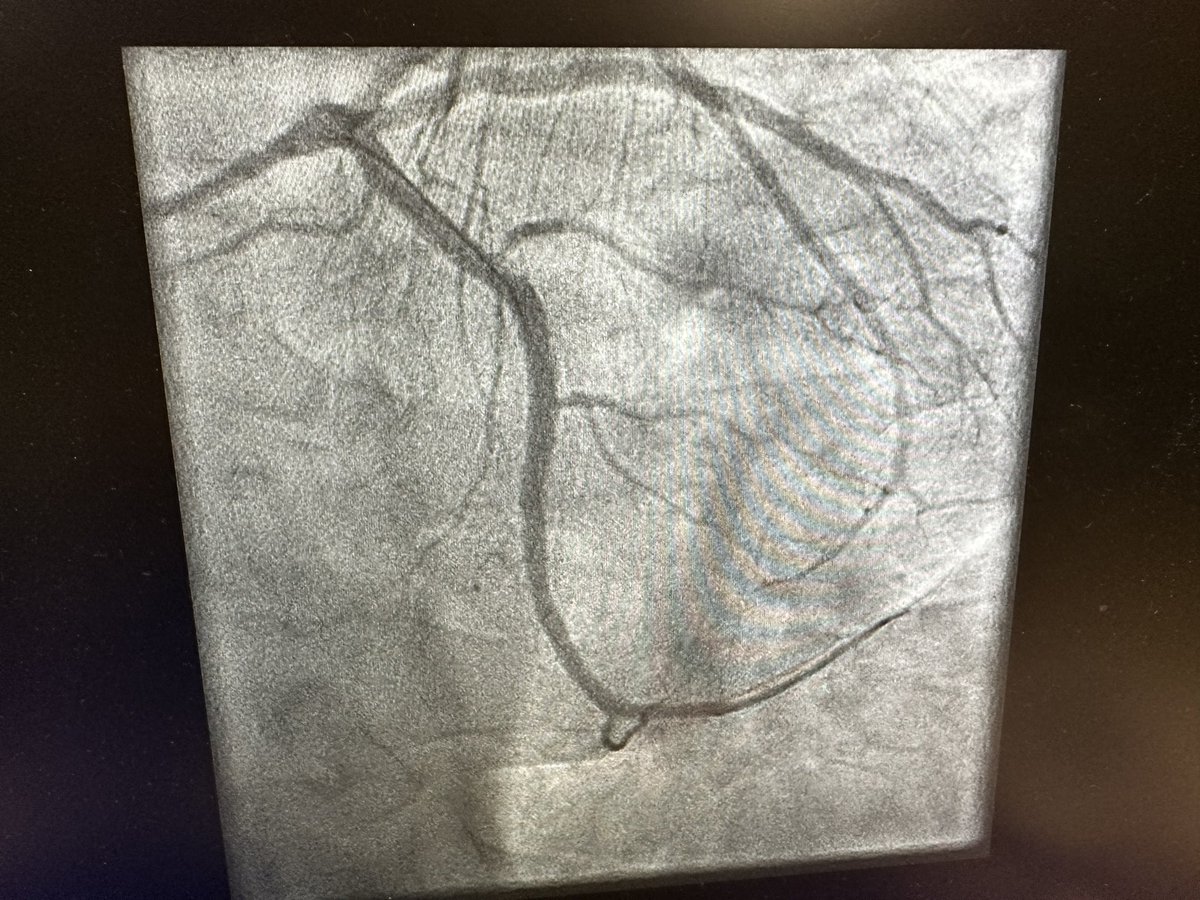 Mamas A. Mamas (@mmamas1973) on Twitter photo NHS failing- 2x ppci overnight. This pt phoned ambulance at 10 pm. Phoned further 21x with worsening CP. at 6am wife chose to drive him in- VF - ivus guided PPCI. 2nd pt- waited 4 hrs for ambulance, wife drove him in. This is not how to run a service <a href="/DrAsifQasim/">Dr Asif Qasim MA PhD FRCP</a> <a href="/ShrillaB/">Dr Shrilla Banerjee MD FRCP 💙</a> NHS failing- 2x ppci overnight. This pt phoned ambulance at 10 pm. Phoned further 21x with worsening CP. at 6am wife chose to drive him in- VF - ivus guided PPCI. 2nd pt- waited 4 hrs for ambulance, wife drove him in. This is not how to run a service <a href="/DrAsifQasim/">Dr Asif Qasim MA PhD FRCP</a> <a href="/ShrillaB/">Dr Shrilla Banerjee MD FRCP 💙</a>