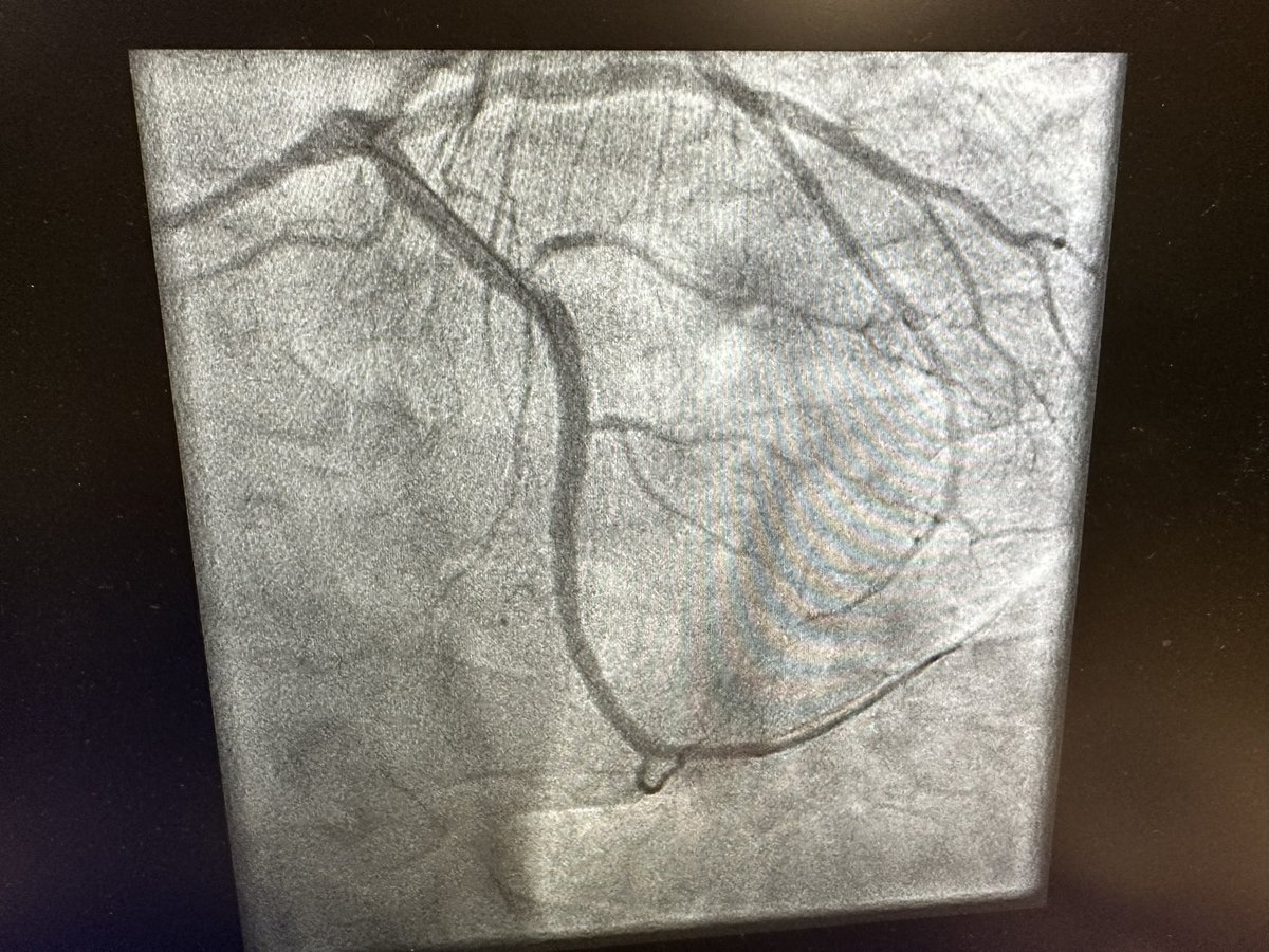 NHS failing- 2x ppci overnight. This pt phoned ambulance at 10 pm. Phoned further 21x with worsening CP. at 6am wife chose to drive him in- VF - ivus guided PPCI. 2nd pt- waited 4 hrs for ambulance, wife drove him in. This is not how to run a service @DrAsifQasim @ShrillaB