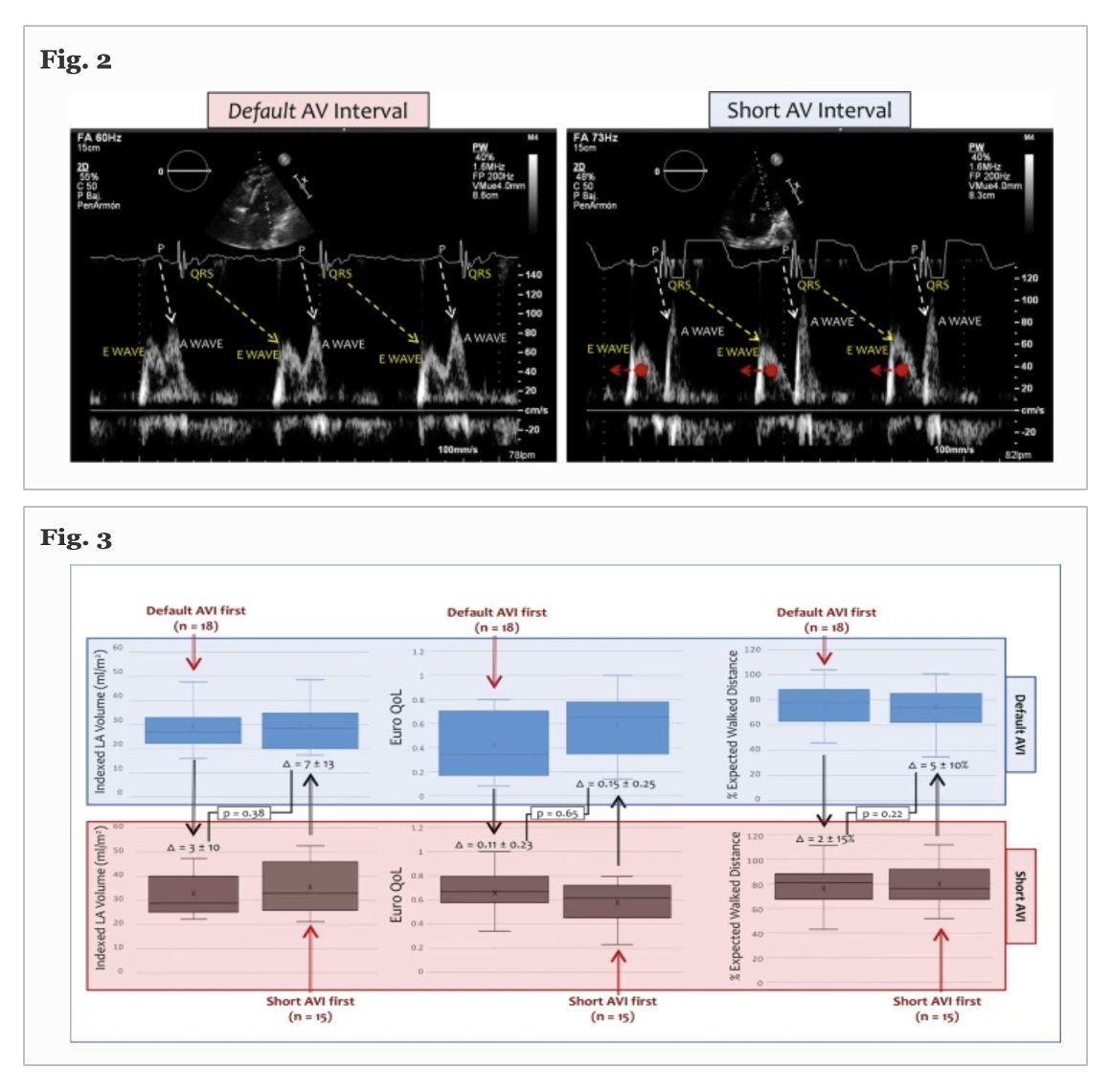 JICE (@jice_ep) on Twitter photo 🚨#FreeRead☕️ <a href="/JICE_EP/">JICE</a>
Inefficient Diastolic Filling in DC-PPM Recipients: Impact of AV Interval Shortening (AVI-SHORT study)
by D Pereferrer <a href="/axel_sarrias/">Axel Sarrias</a> <a href="/Raquel_Adelino/">Raquel Adeliño</a> <a href="/bisbal_EP/">Felipe Bisbal</a> <a href="/AranyoJulia/">Julia Aranyó</a> <a href="/NuriaVallejo4/">Nuria Vallejo</a> <a href="/rogervilluendas/">Roger Villuendas</a> <a href="/VictorBazanG/">Victor Bazan</a>
🆓📖 rdcu.be/cW9Du
#EPeeps 🚨#FreeRead☕️ <a href="/JICE_EP/">JICE</a>
Inefficient Diastolic Filling in DC-PPM Recipients: Impact of AV Interval Shortening (AVI-SHORT study)
by D Pereferrer <a href="/axel_sarrias/">Axel Sarrias</a> <a href="/Raquel_Adelino/">Raquel Adeliño</a> <a href="/bisbal_EP/">Felipe Bisbal</a> <a href="/AranyoJulia/">Julia Aranyó</a> <a href="/NuriaVallejo4/">Nuria Vallejo</a> <a href="/rogervilluendas/">Roger Villuendas</a> <a href="/VictorBazanG/">Victor Bazan</a>
🆓📖 rdcu.be/cW9Du
#EPeeps