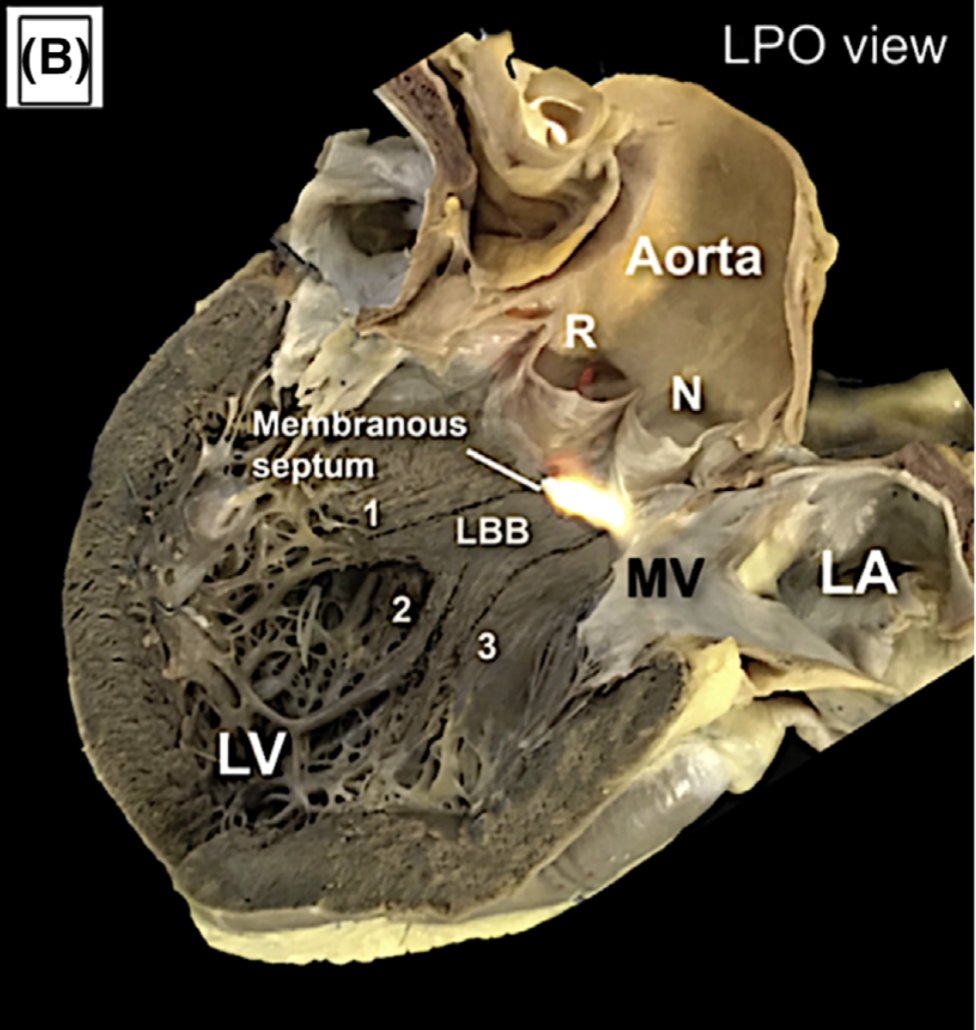 pzhong2016's tweet photo. Cardiac conduction system anatomy and pacing https://t.co/jCwPQdFzP4