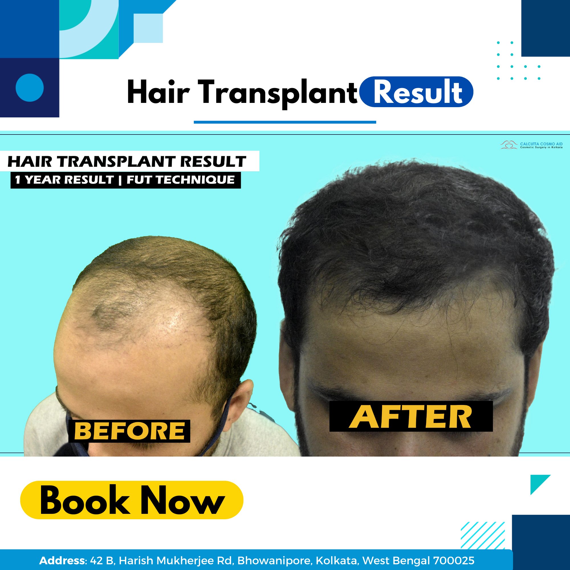 Dr Anand K Nagwani - Hair Transplant on X: Breast Augmentation is