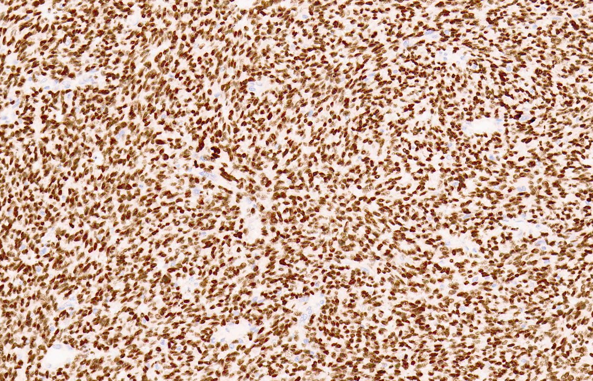 MALIGNANT GIANT CELL TUMOUR OF BONE. NB: conventional giant cell tumour; metastasis with sheets of spindle-epithelioid cells and occasional seams of osteoid; ovoid nuclei with macronucleoli; brisk mitotic activity, including atypical figures; IHC: H3.3 G34W (PMID: 28505000).