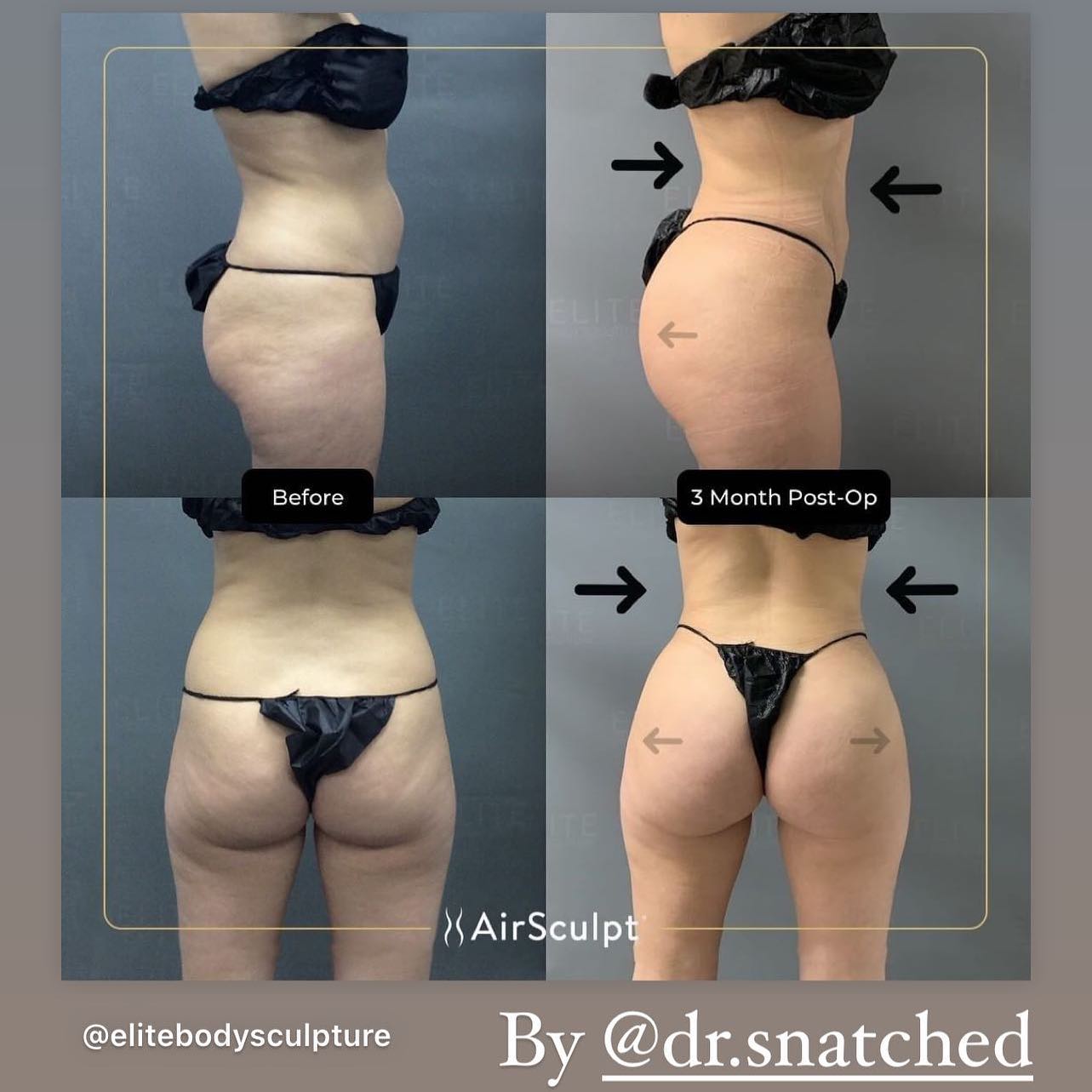 Post-Liposuction Garment Care: Maximizing Your Faja's Lifespan – Daniel J  Farrugia MD PhD FACS – Liposuction, Fat Transfer, BBL in Chicago