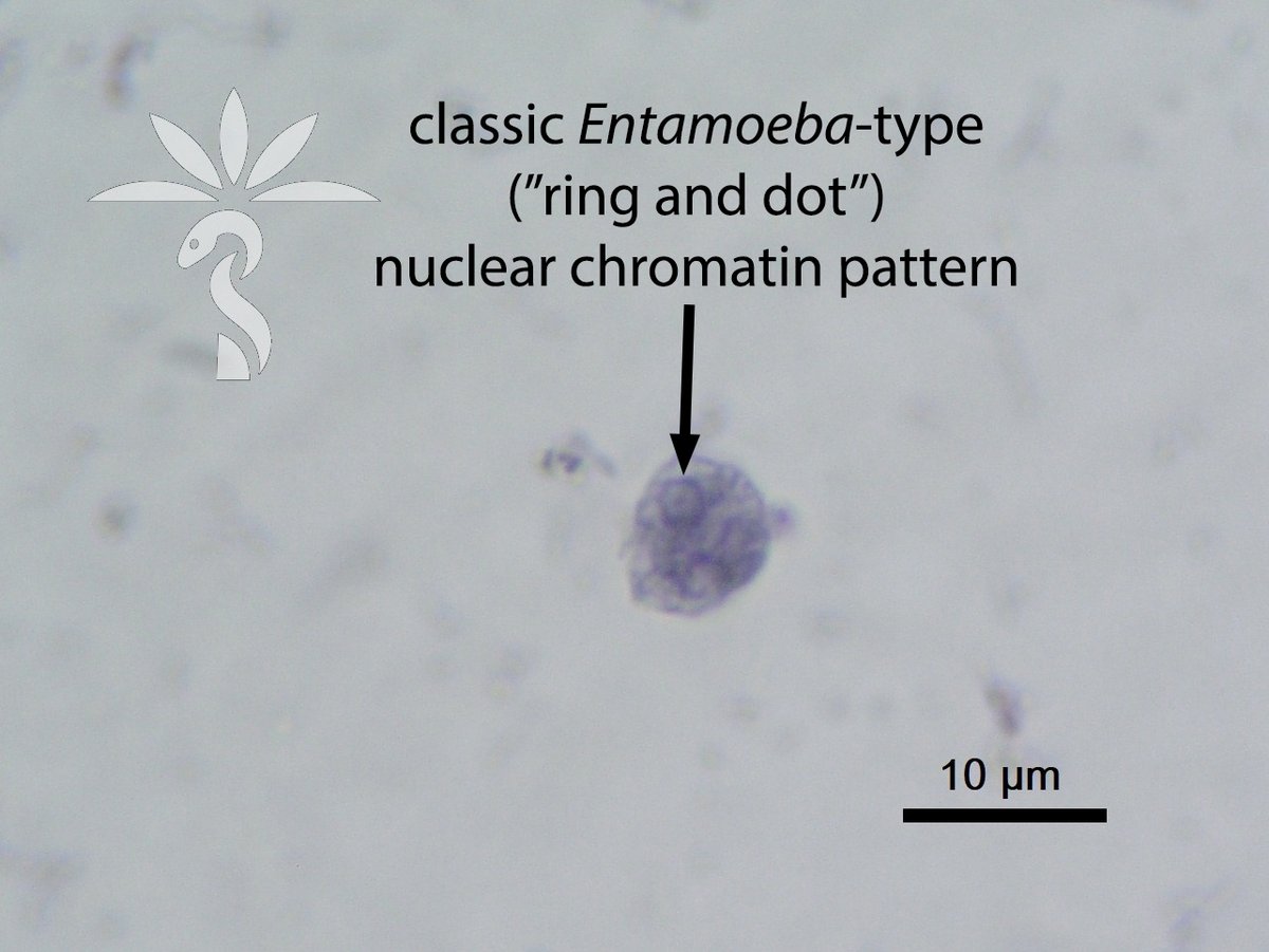 The answer to the Parasite Case 697 is up: Entamoeba hartmanni – it looks like E. histolytica/E. dispar, but smaller! parasitewonders.blogspot.com/2022/10/answer… #mayopath #pathology #path2path #MayoClinMicro #CrittersOnTwitter @ITMantwerp