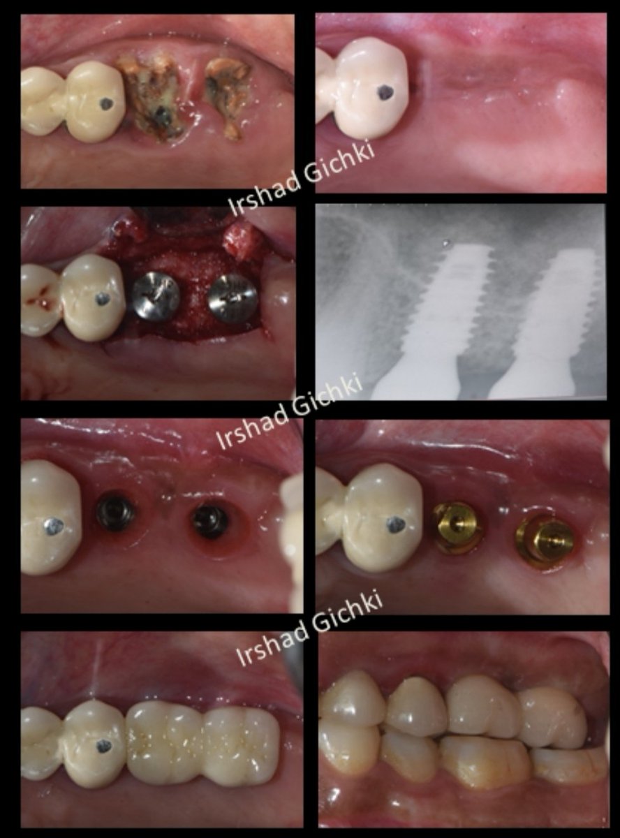 DrAlbaloshi88's tweet photo. Maxillary sinus floor elevation, Bone grafting, with simultaneous implant placement to restore missing maxillary 1st and 2nd molar!
#implantdentistry #implantology #sinuslift
#dentistlife #periodontist #quettadentist https://t.co/XUkG0FM55D