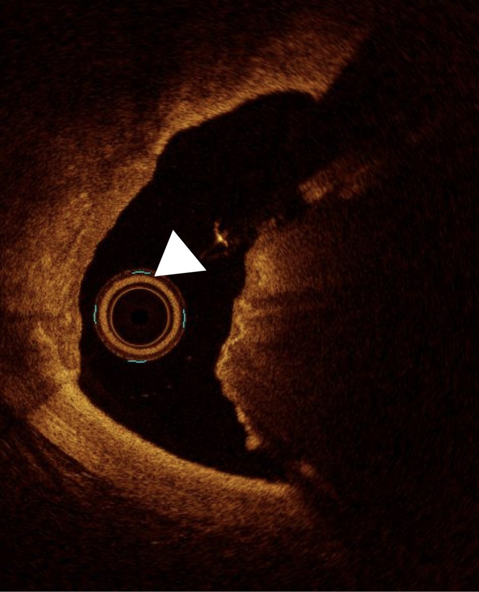 @NeerajShahMD @rotamonster @iSagarReddy @evandrofilhobr @ShariqShamimMD @agtruesdell @AntoniousAttall 1/There are two types of nodules with two possible behaviors. Types of nodules 1) Eruptive (like glass shards sticking out of a pillow) 2) Non-eruptive protruding (like a bowling ball protruding out of a pillow)