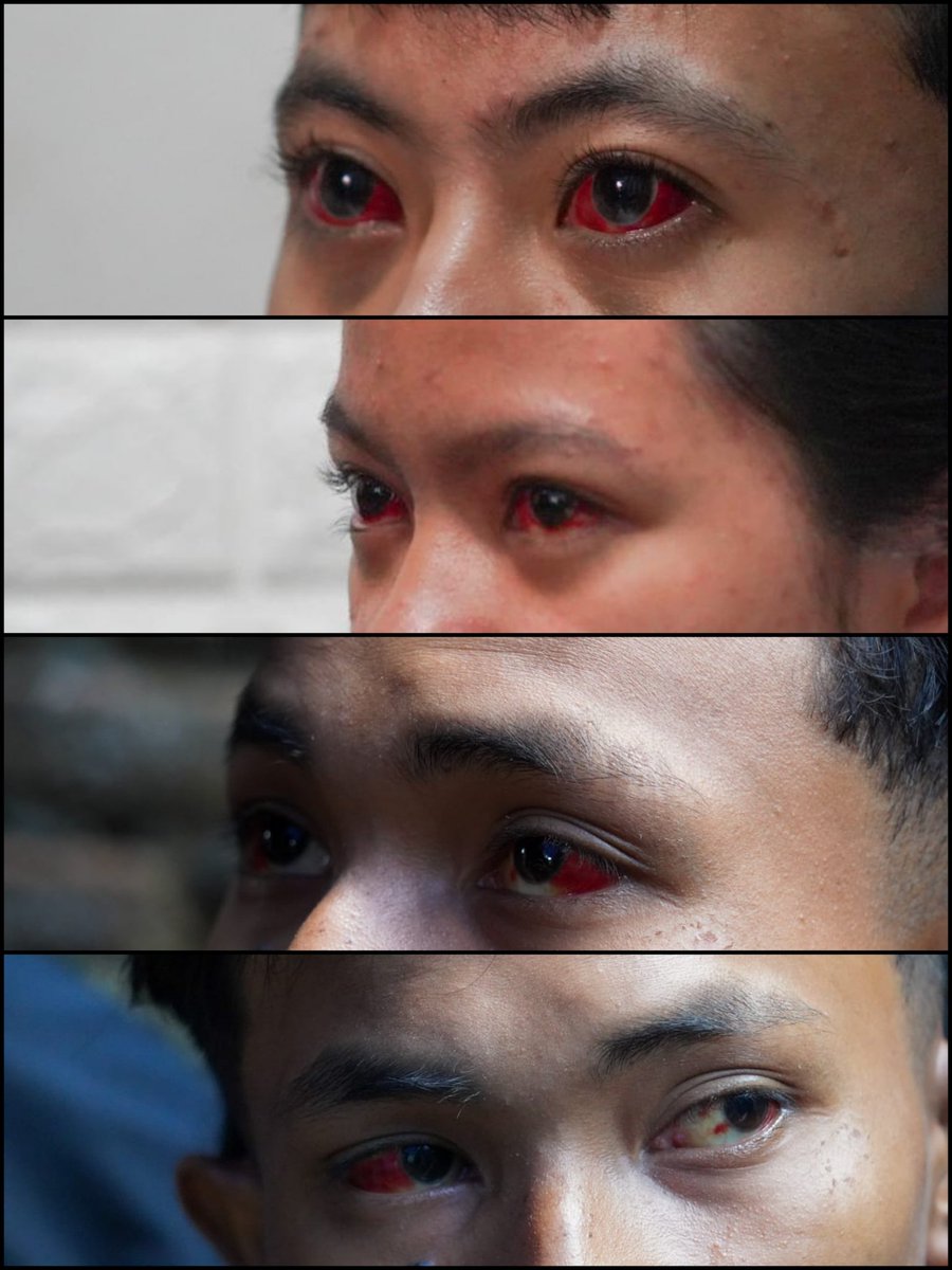 Seminggu berlalu, seperti inilah kondisi saat ini beberapa korban #TragediKanjuruhan : Pendarahan dalam mata, sesak, batuk-batuk, cidera hingga ada korban yang Retina matanya sampai detik ini tak ada warna putihnya

TGIPF :"Semua gara-gara gas air mata"

#USUTTUNTAS