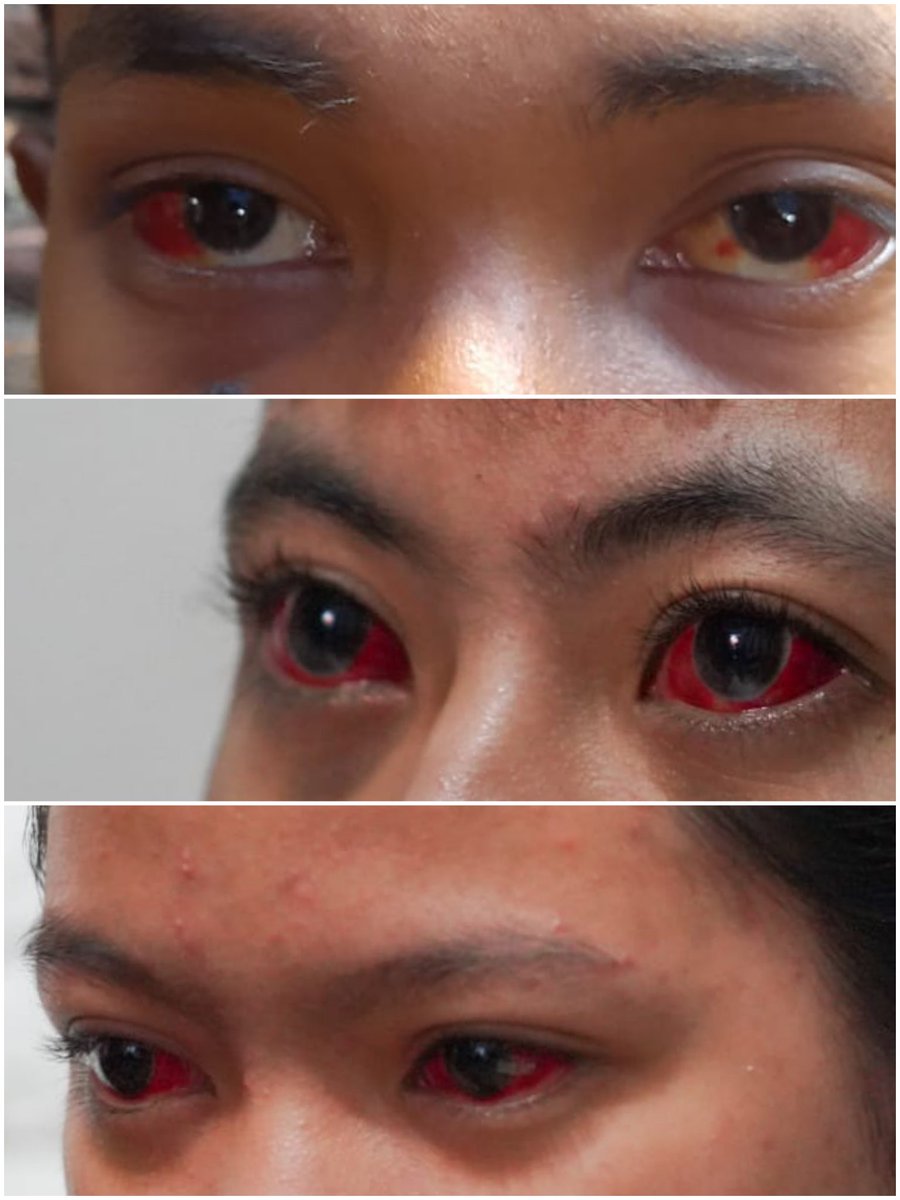Sudah seminggu, kondisi mata korban gas air mata di Kanjuruhan masih merah seperti ini. Sumber : Save Our Soccer.