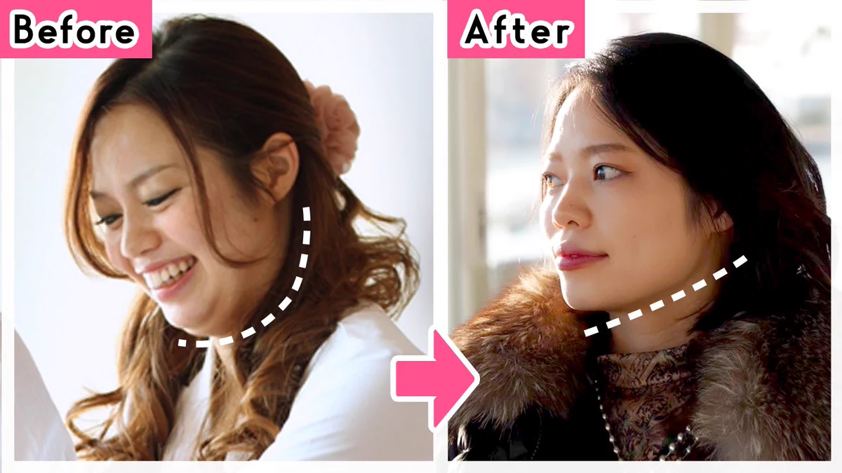 このbefore、afterを見よ。3万人施術してきていきついた「小顔」最強最速のやり方