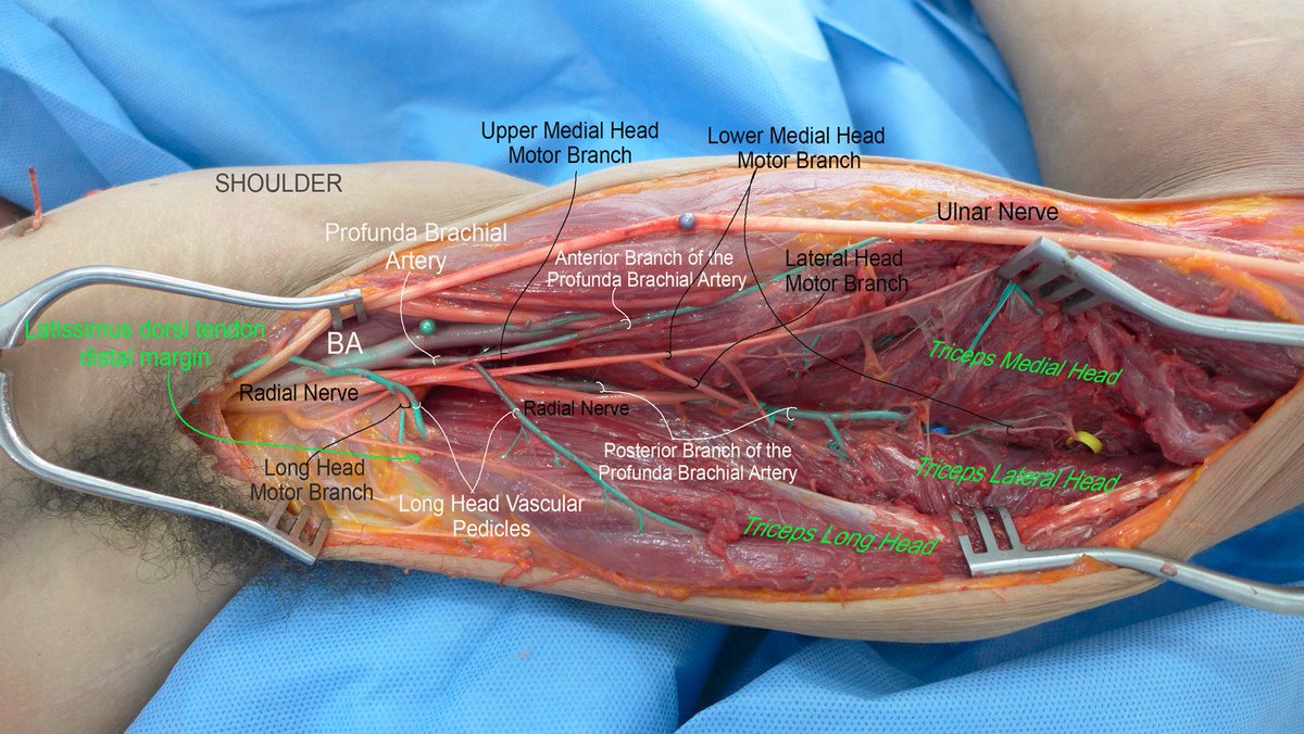 Impressive view on the brachial artery and adjacent structures 😳 pubmed.ncbi.nlm.nih.gov/35965142/ Left axilla and arm 💪 fresh cadaveric dissection after green latex arterial injection.