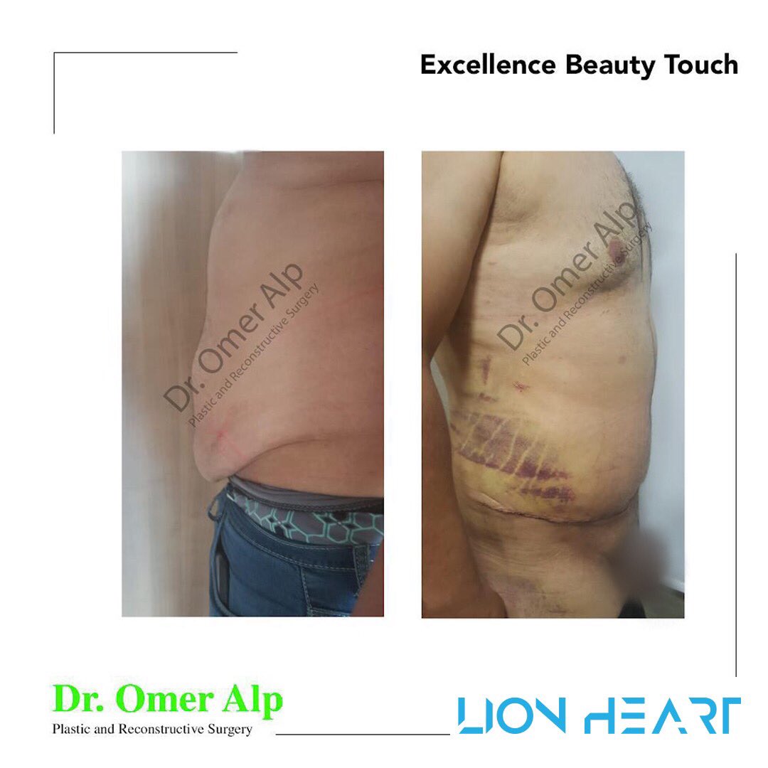 Little touches, big differences!

#lionhearthealthcare #medicaltourism #hairtransplant #aesthetics #plasticsurgery
#drcemyilmaz #turkishmedicine #breastaesthetic #breast #breastaesthetics #nose #nosesurgery #noseaesthetic