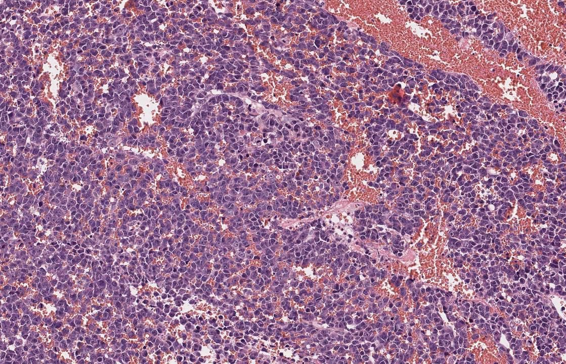 FelipePatologia's tweet photo. Adult woman, nasal mass.

Quiz in the thread.

IHC will be posted later.

What do you think?

#pathtwitter #ENTpath #HNpath

@GeronimoJrLapac @RawiaMo57385655 https://t.co/7YXLxeG4mi