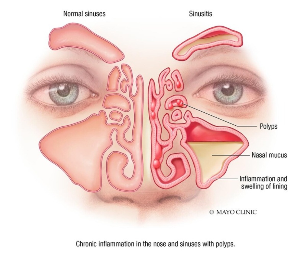 Mayo Clinic ENT (@mayoclinicent) on Twitter photo How effective are topical antibiotics for AERD patients with positive perioperative sinonasal bacterial culture who have undergone endoscopic sinus surgery?
Click to learn more: bit.ly/3e3Szb1
#MayoENTresearch #ENT #Rhinology @JStokken <a href="/ErinOBrienMD/">Erin K O'Brien MD</a> #GarretChoby How effective are topical antibiotics for AERD patients with positive perioperative sinonasal bacterial culture who have undergone endoscopic sinus surgery?
Click to learn more: bit.ly/3e3Szb1
#MayoENTresearch #ENT #Rhinology @JStokken <a href="/ErinOBrienMD/">Erin K O'Brien MD</a> #GarretChoby