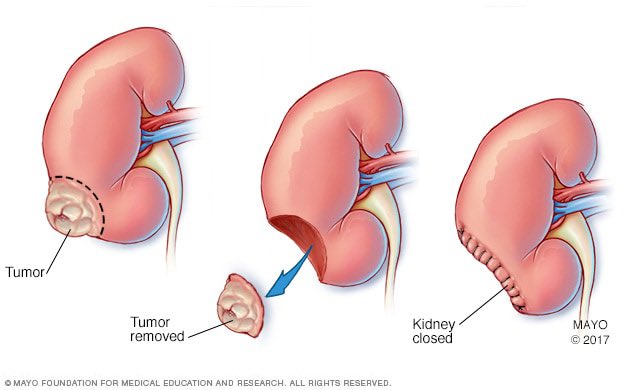 Partial nephrectomy is often performed for renal tumors in order to preserve renal function.

Absolute indications include bilateral tumors or solitary kidney, while a relative indication is a cancer syndrome. Ideal candidates vary based on tumor size, location, and surgeon skill