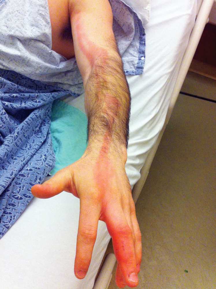 A 23-year-old man presented with rapidly progressive left arm pain and erythema. His left third finger was injured during a lacrosse game. Overnight, the finger became increasingly painful, with erythema spreading to the wrist. What is the likely diagnosis? #Medtwitter
