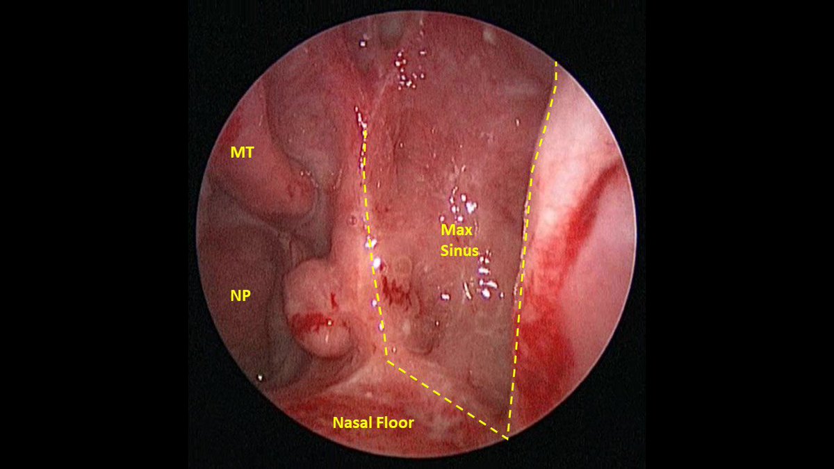 JohnCraigNose's tweet photo. 3rd annual #HFSNS = awesome. One big sinus topic was recalcitrant non-odonto maxillary sinusitis after sinus surgery: endo medial maxillectomy often saves the day, but more research needed for optimal topical vs systemic therapies for ongoing sinusitis. @henryfordent #MedTwitter https://t.co/5gAEvv8bYd