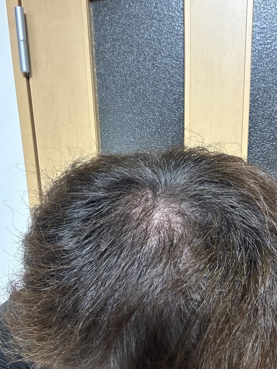 kq_qv2's tweet photo. 植毛して約3週間。ショックロスが若干始まってるような気もするけど早く来て早く新しいの生えて欲しい。あと後頭部のデキモノが術後からずっと残ってて掻くと痛い https://t.co/UaP8rHAW2T