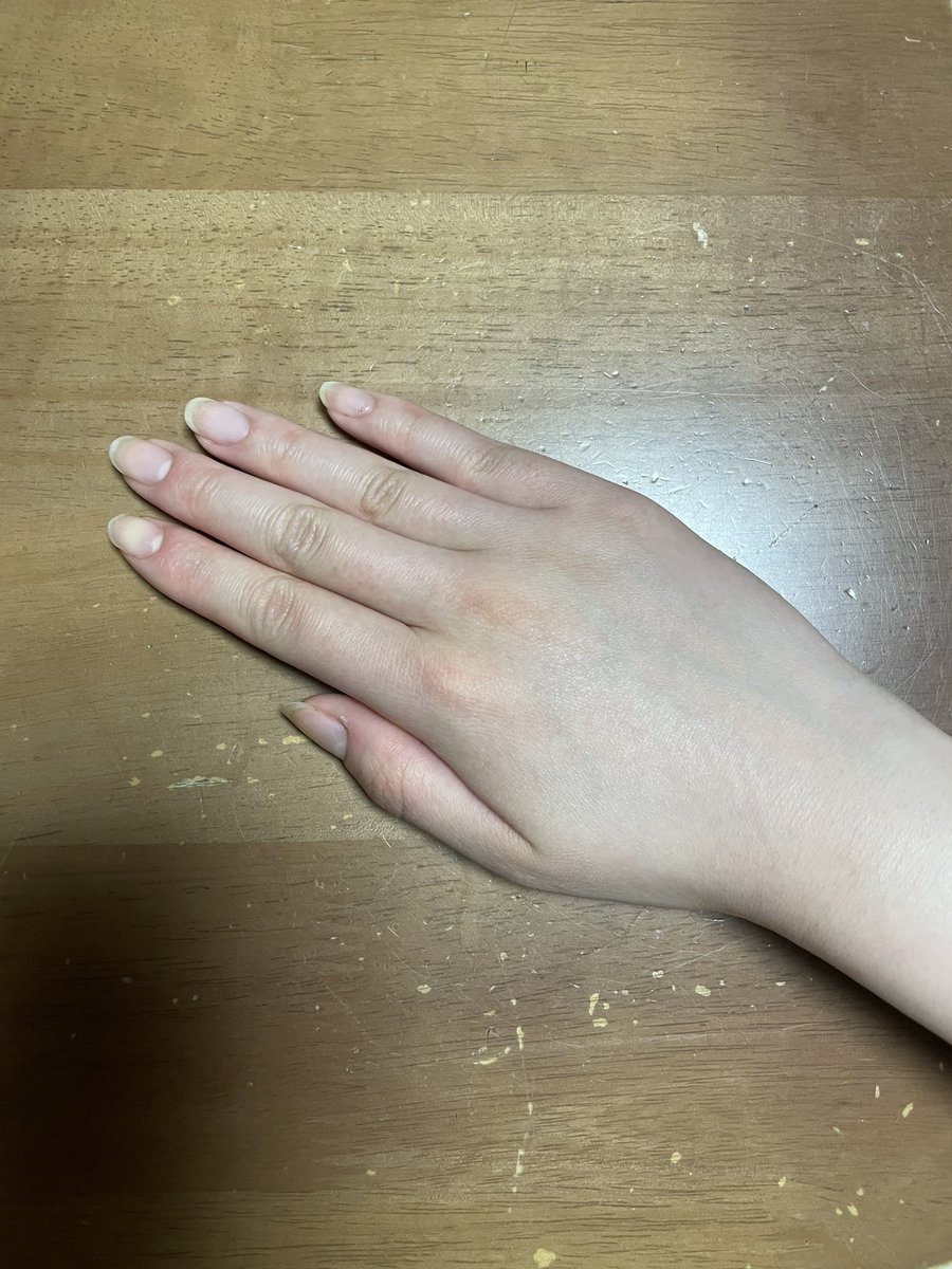 BIGamnosLOVE's tweet photo. 5年でこんなに変わった😭😭
爪いじりすぎたし、皮もいっぱいむいでたから
相当汚くてコンプレックスだった。。
ハンドクリーム塗ったりしたけど、一番の効果は爪を伸ばしてネイル塗ることだったかなぁ
そしたら爪も噛まないし、横の皮もめくらなかった！
爪がコンプレックスの人一緒に頑張ろ☺
#育爪 https://t.co/g3mskuCign