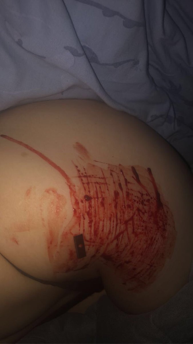 cutmelol's tweet photo. hi again 

shtwt ouchietwt beanstwt goretwt bloodtwt styrotwt 198twt armgillstwt obslovetwt raspberryfillingtwt https://t.co/XGWcLASIEb